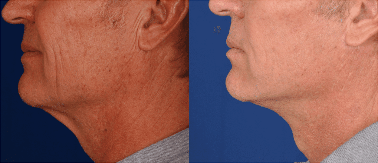 Neck Lift Before and After Photo