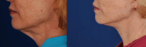 Neck Lift Before and After Photos