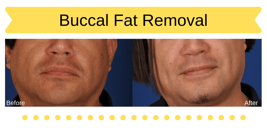 Man before and after buccal fat removal